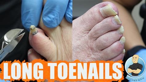 toenails hard and thick